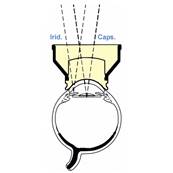 Ocular - Mandelkorn Iridotomie-Capsulotomie Laser